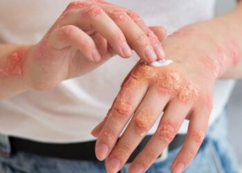 Psoriaze sergančio paciento rankos sausa ranku oda