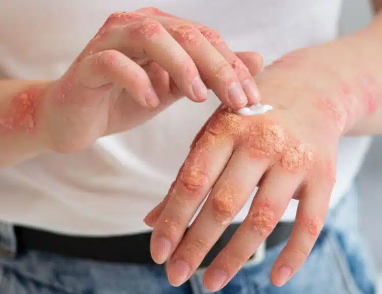 Psoriaze sergančio paciento rankos sausa ranku oda